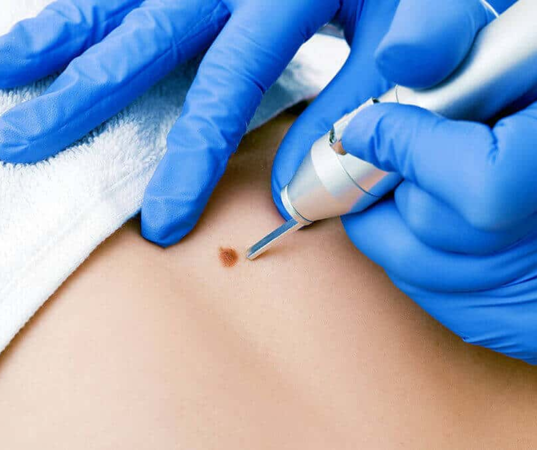 CryoSurgery Supplies