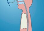 Dynamic-stent-300×362-1