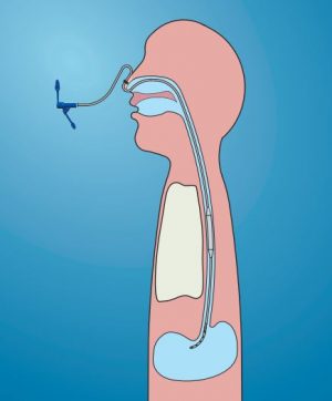 Dynamic Stent™