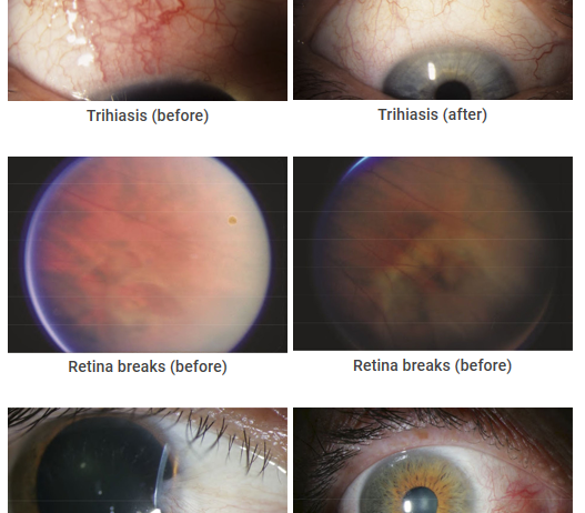 OPHTHALMOLOGY – CRYO-S Electric