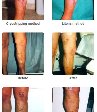 PHLEBOLOGY – CRYO-S Electric