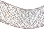 pyloric-300×190-1