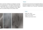 EGIS Biliary Stent
